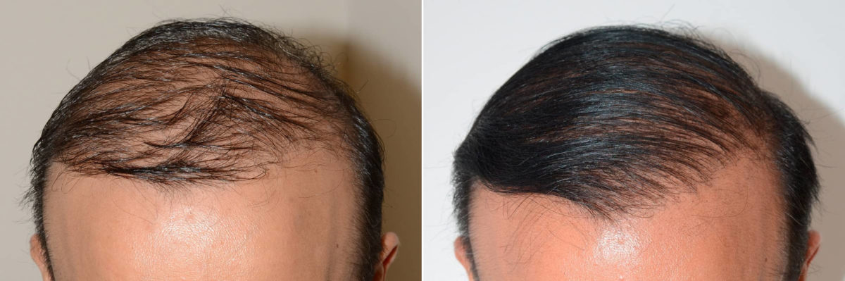 Body Hair Transplant Before and after in Miami, FL, Paciente 59729