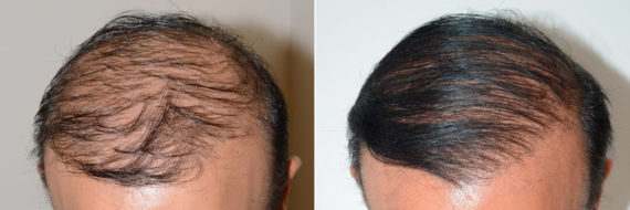 Body Hair Transplant Before and after in Miami, FL, Paciente 59729