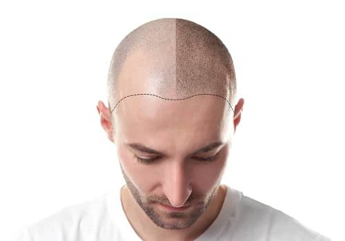 How Do You Fix a Bad Hair Transplant?