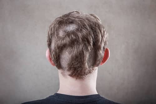 Teens and Hair Transplants article