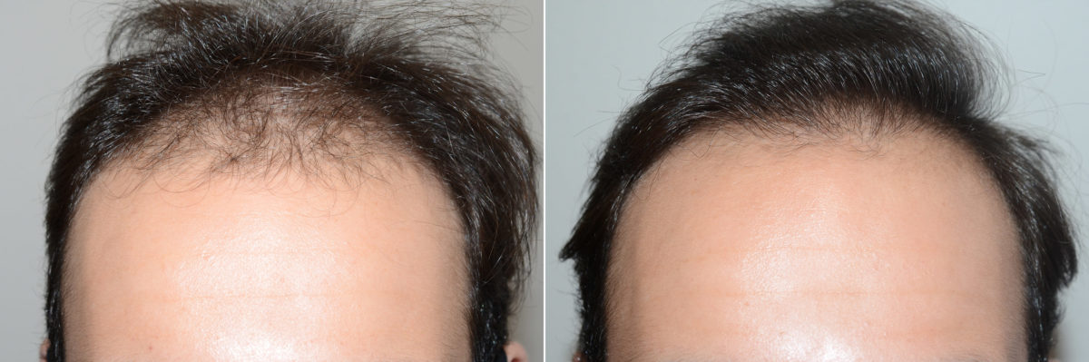 Hair Transplants for Men Before and after in Miami, FL, Paciente 119320