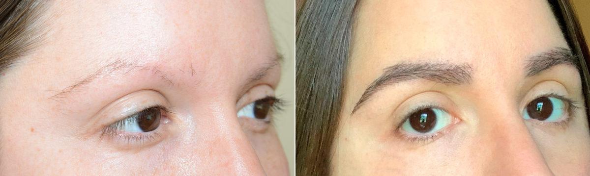 Eyebrow Hair Transplant Before and after in Miami, FL, Paciente 119576