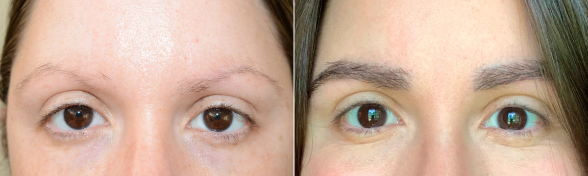 Eyebrow Before and after in Miami, FL, Paciente 119576