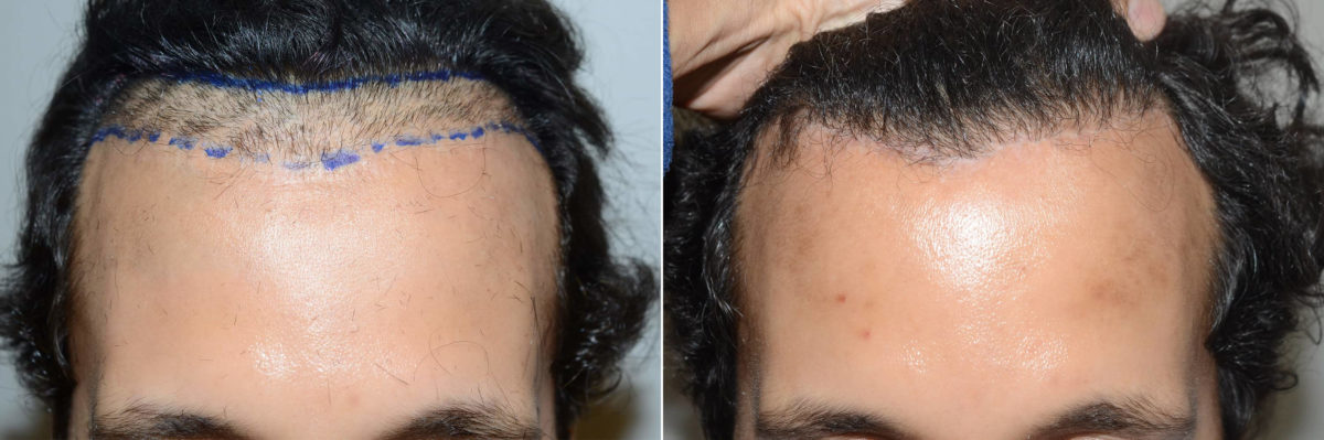 Hair Transplants for Men Before and after in Miami, FL, Paciente 121457