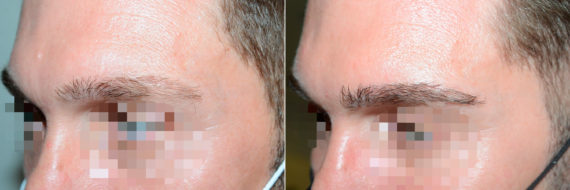 Eyebrow Hair Transplant Before and after in Miami, FL, Paciente 121497