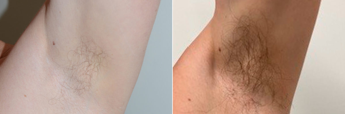 Body Hair Transplant Before and after in Miami, FL, Paciente 121505