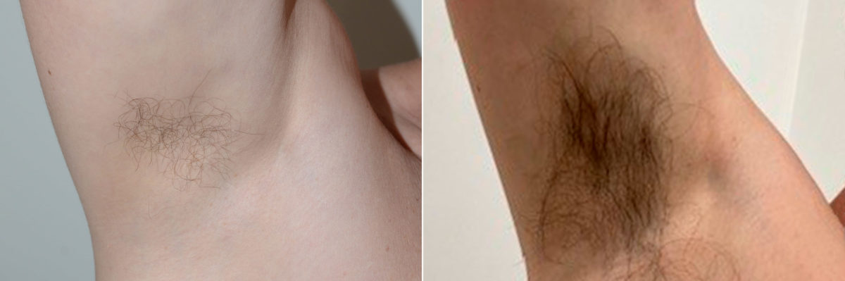Body Hair Transplant Before and after in Miami, FL, Paciente 121505