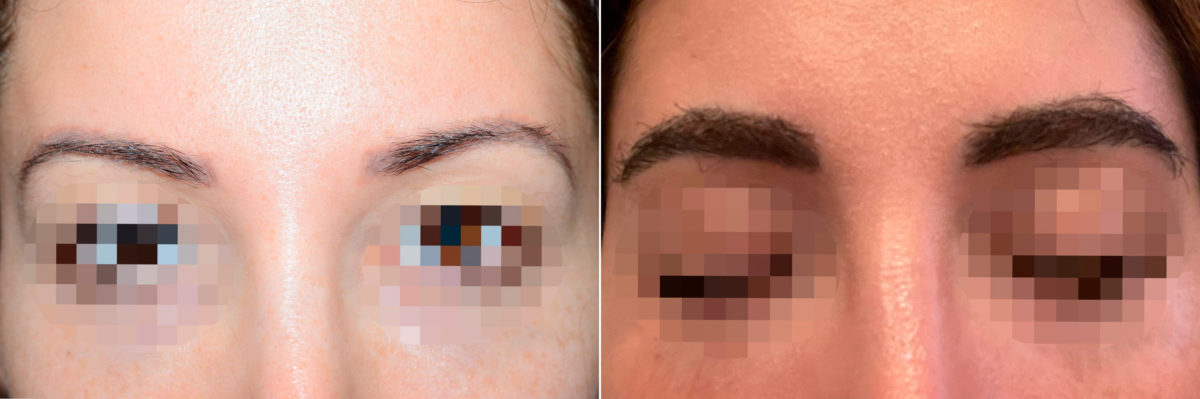 Eyebrow Hair Transplant Before and after in Miami, FL, Paciente 121618
