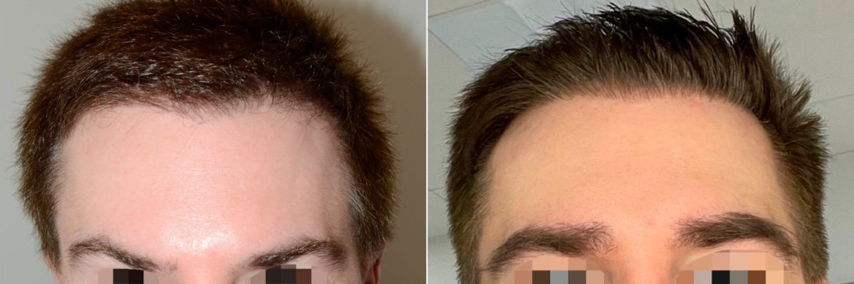 Eyebrow Hair Transplant Before and after in Miami, FL, Paciente 121673