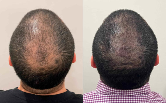 Scalp Micropigmentation Before and after in Miami, FL, Paciente 121705