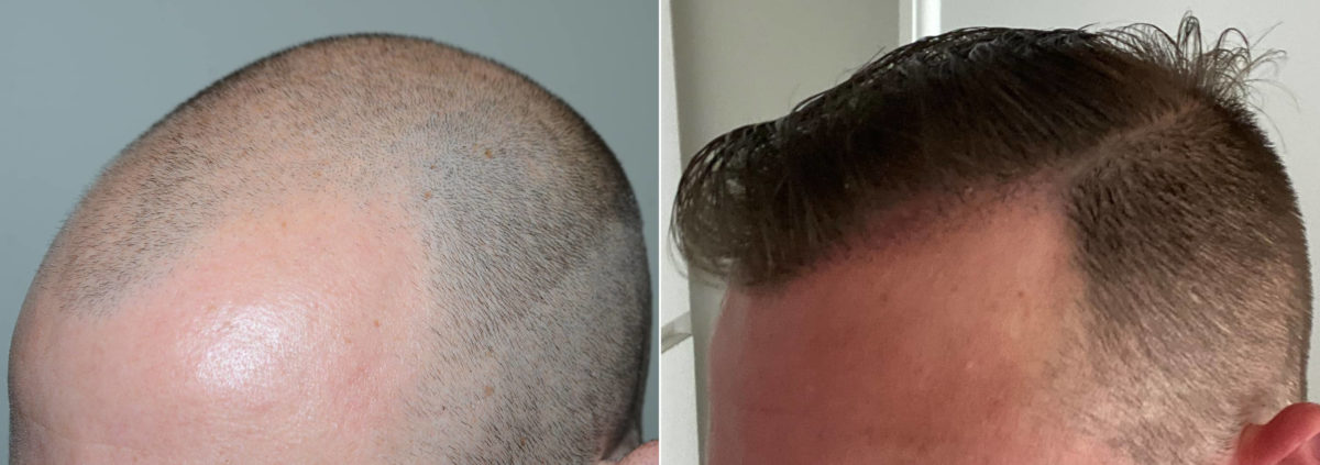 Hair Transplants for Men Before and after in Miami, FL, Paciente 117285