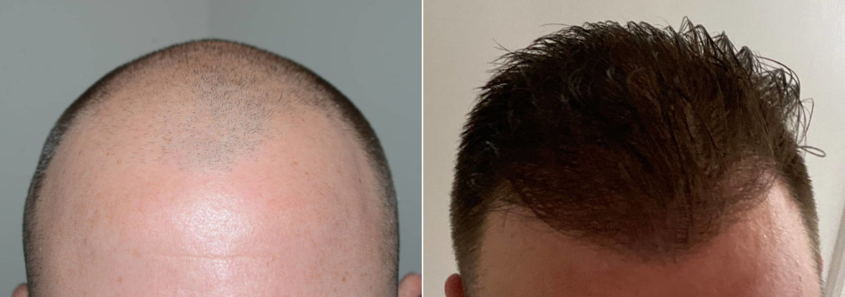 Hair Transplants for Men Before and after in Miami, FL, Paciente 117285
