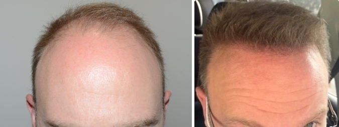 Hair Transplants for Men Before and after in Miami, FL, Paciente 117344