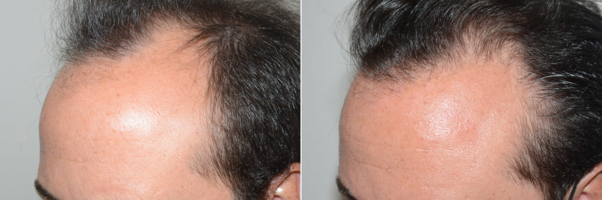 Hair Transplants for Men Before and after in Miami, FL, Paciente 119301