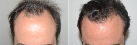Hair Transplants for Men Before and after in Miami, FL, Paciente 119301