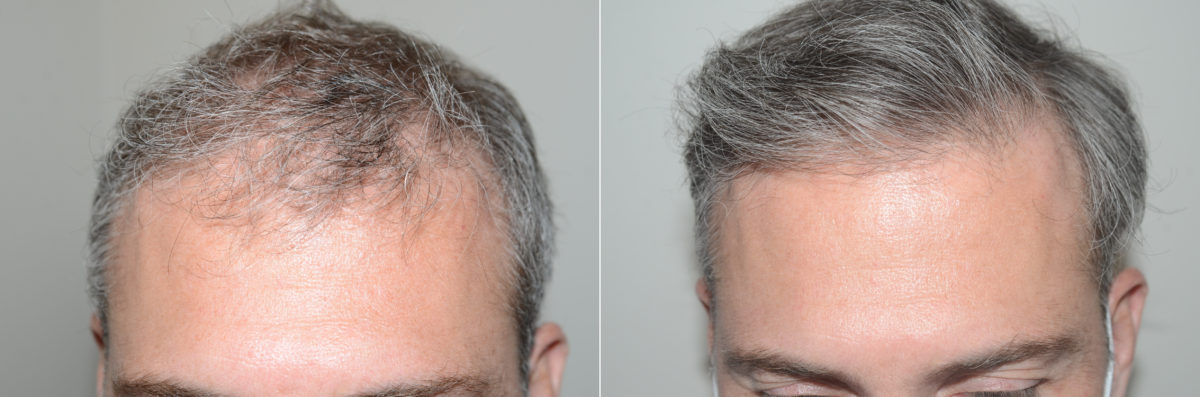 Hair Transplants for Men Before and after in Miami, FL, Paciente 123029