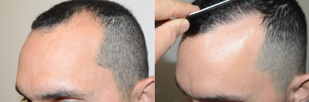 Hair Transplants for Men Before and after in Miami, FL, Paciente 123091