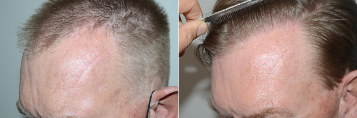 Hair Transplants for Men Before and after in Miami, FL, Paciente 123096