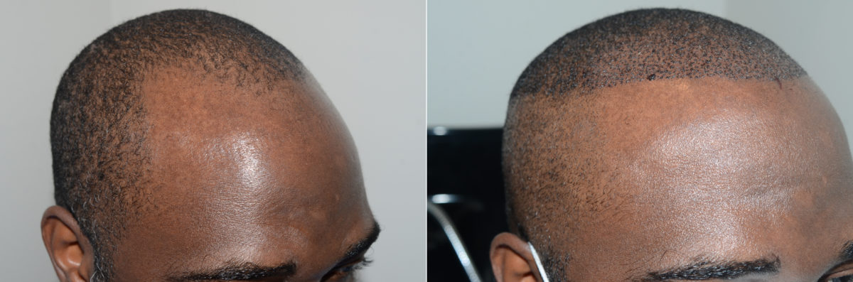 Hair Transplants for Men Before and after in Miami, FL, Paciente 123113