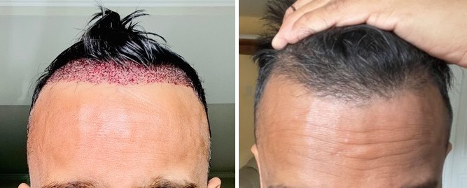 Hair Transplants for Men Before and after in Miami, FL, Paciente 123140