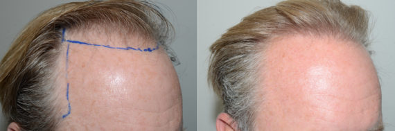 Hair Transplants for Men Before and after in Miami, FL, Paciente 123149