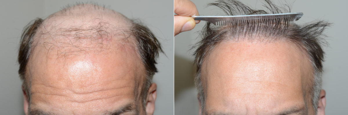 Hair Transplants for Men Before and after in Miami, FL, Paciente 123162