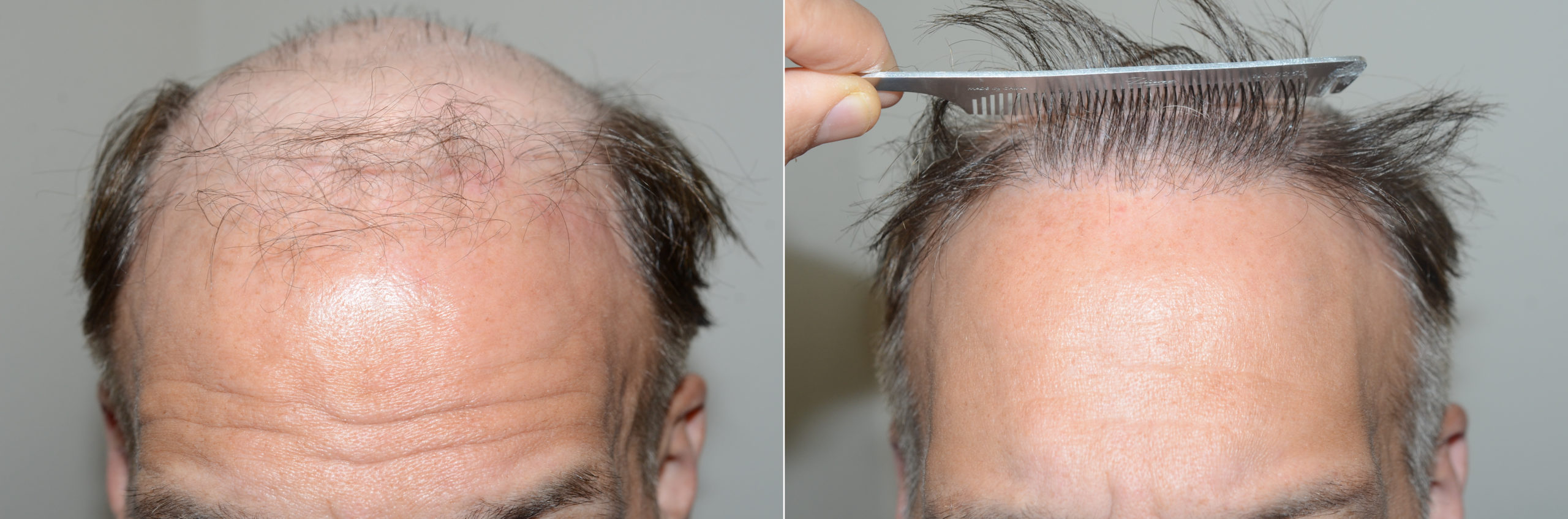 Hair Transplants for Men photos | Miami, FL | Patient123162