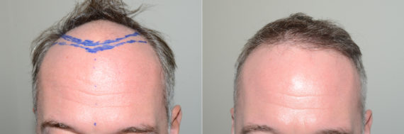 Hair Transplants for Men Before and after in Miami, FL, Paciente 123181