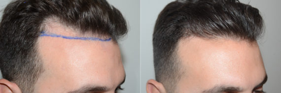 Forehead Reduction Surgery Before and after in Miami, FL, Paciente 123194