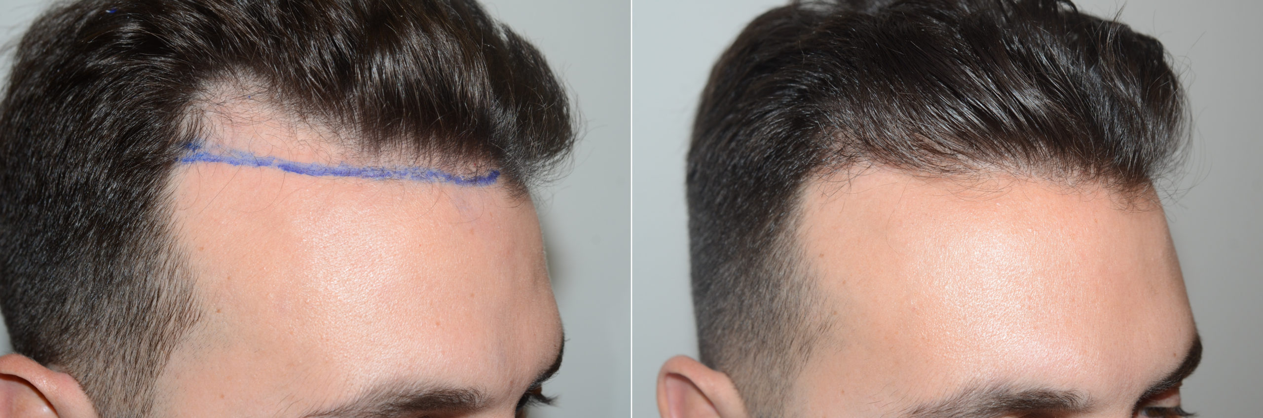 Forehead Reduction Surgery, Hair Transplants for Men photos | Miami, FL |  Patient123194
