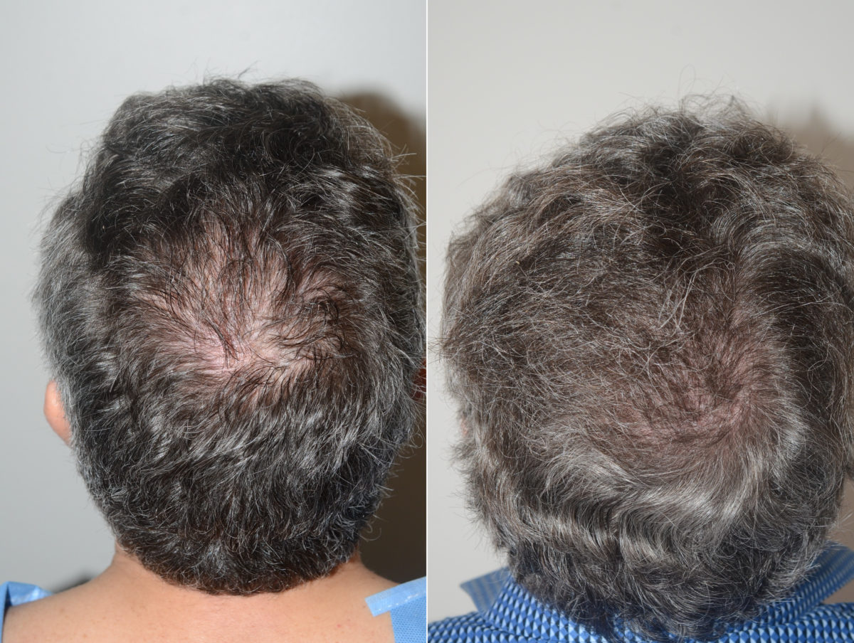 Hair Transplants for Men Before and after in Miami, FL, Paciente 123219