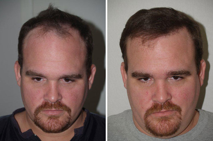 Hair Transplants for Men Before and after in Miami, FL, Paciente 37655