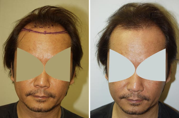 Hair Transplants for Men Before and after in Miami, FL, Paciente 38011
