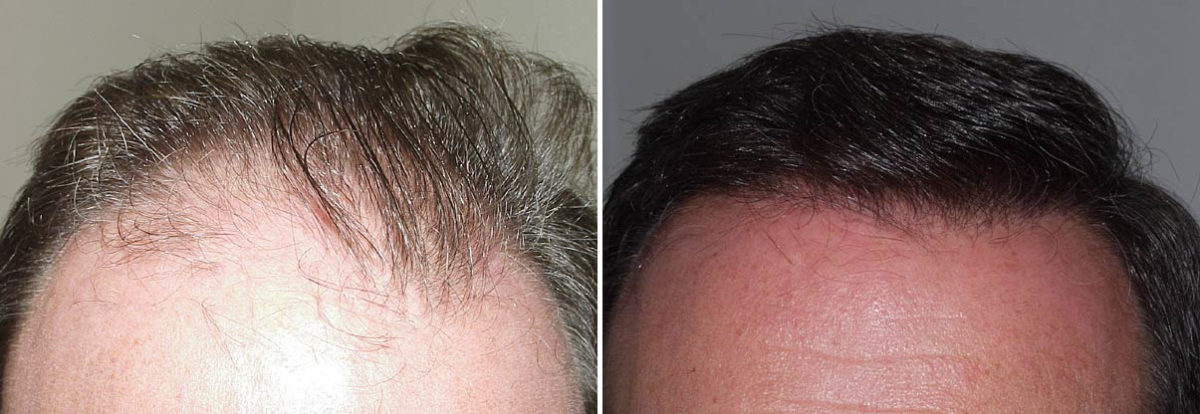 Hair Transplants for Men Before and after in Miami, FL, Paciente 38164