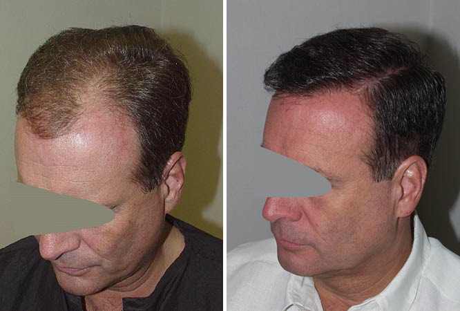 Hair Transplants for Men Before and after in Miami, FL, Paciente 38164
