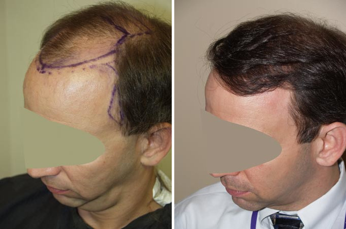 Hair Transplants for Men Before and after in Miami, FL, Paciente 38479