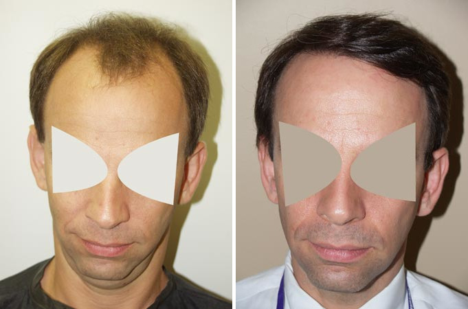 Hair Transplants for Men Before and after in Miami, FL, Paciente 38479