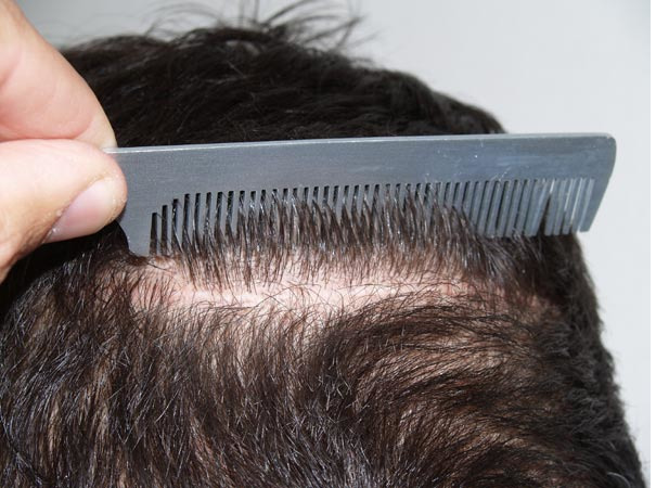 Hair Transplants for Men Before and after in Miami, FL, Paciente 38899