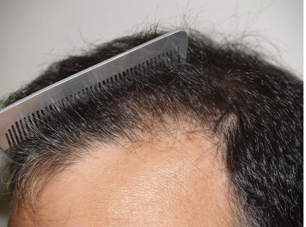 Hair Transplants for Men Before and after in Miami, FL, Paciente 39026