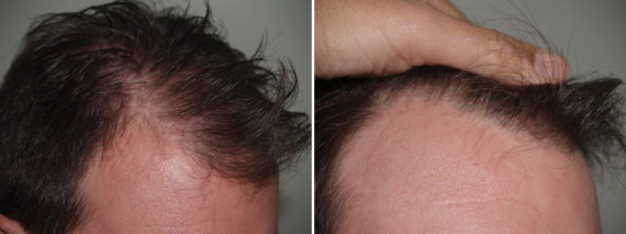 Hair Transplants for Men Before and after in Miami, FL, Paciente 39763
