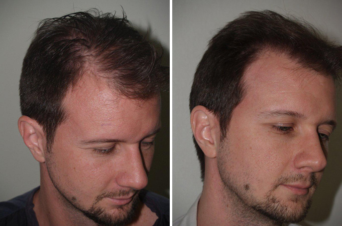 Hair Transplants for Men Before and after in Miami, FL, Paciente 39763