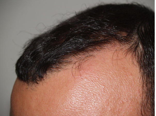 Hair Transplants for Men Before and after in Miami, FL, Paciente 39796
