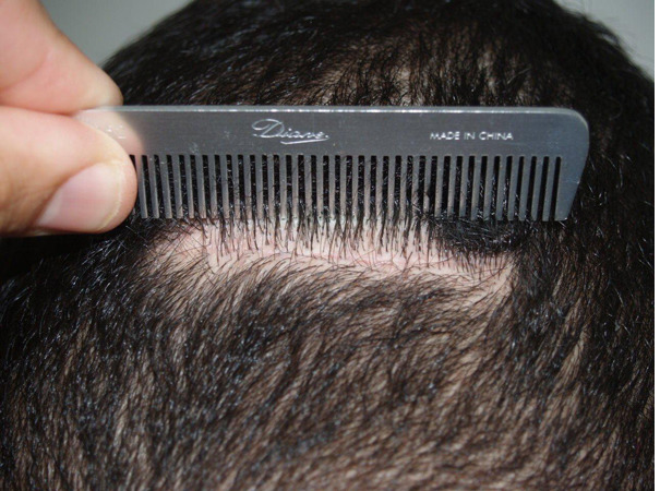 Hair Transplants for Men Before and after in Miami, FL, Paciente 39796