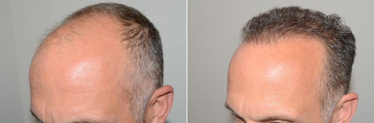 Hair Transplants for Men Before and after in Miami, FL, Paciente 123368