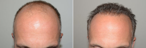 Hair Transplants for Men Before and after in Miami, FL, Paciente 123368
