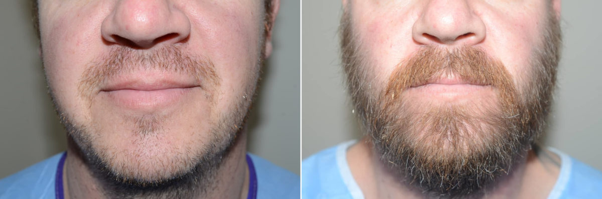 Facial Hair Transplant Before and after in Miami, FL, Paciente 123387