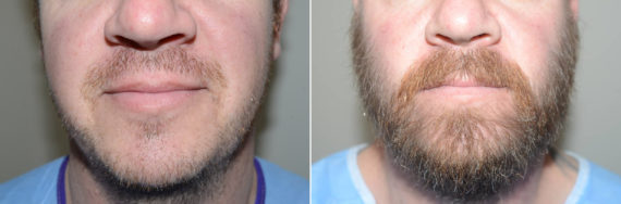 Facial Hair Transplant Before and after in Miami, FL, Paciente 123387