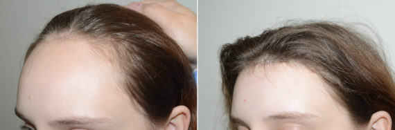 Forehead Reduction Surgery Before and after in Miami, FL, Paciente 123406
