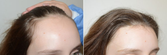 Hairline Advancement Before and after in Miami, FL, Paciente 123406