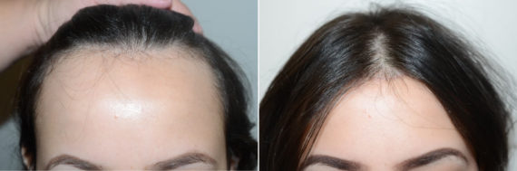 Forehead Reduction Surgery Before and after in Miami, FL, Paciente 123459
